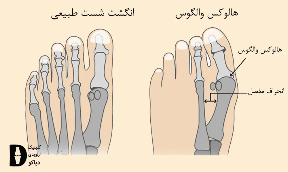 انحراف شست پا