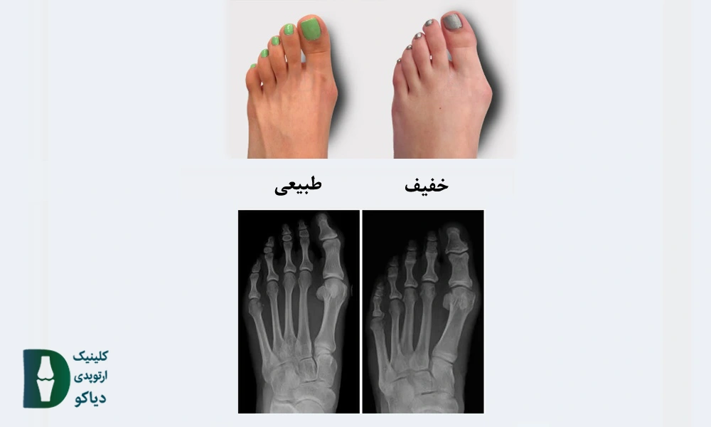 تشخیص شدت هالوکس والگوس 