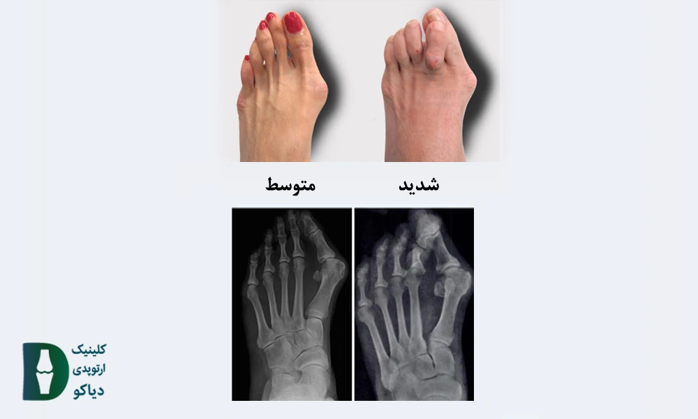 تشخیص شدت هالوکس والگوس 