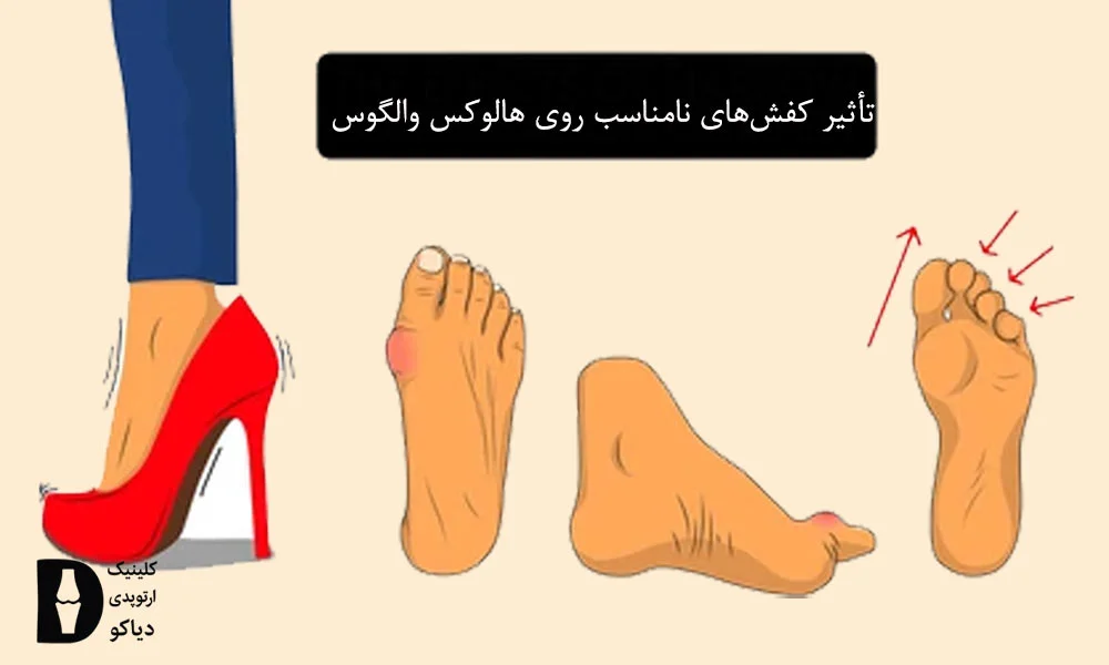 تأثیر کفش‌های نامناسب روی هالوکس والگوس