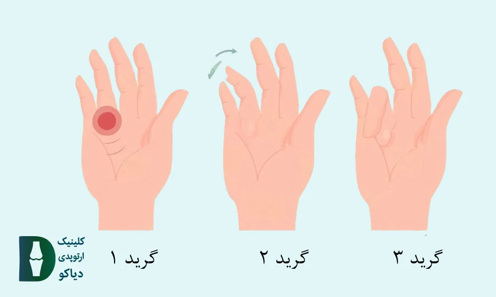 درجه‌بندی شدت انگشت ماشه‌ای