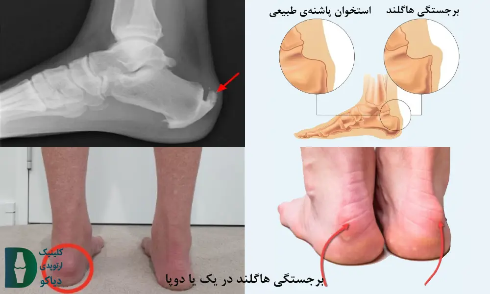برجستگی پشت پاشنه‌ی پا