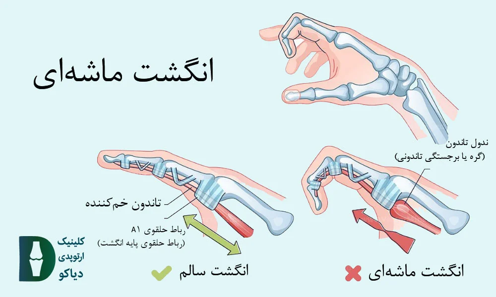 انگشت ماشه‌ای در بزرگسالان