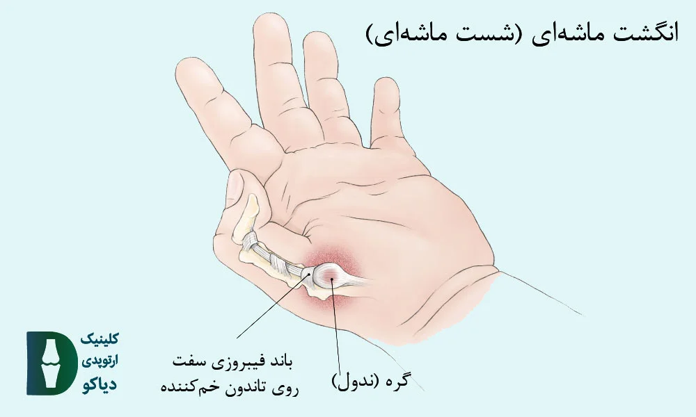 انگشت ماشه‌ای در کودکان