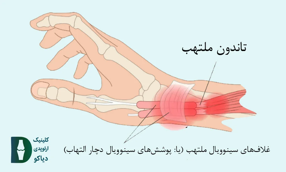 دوکورون