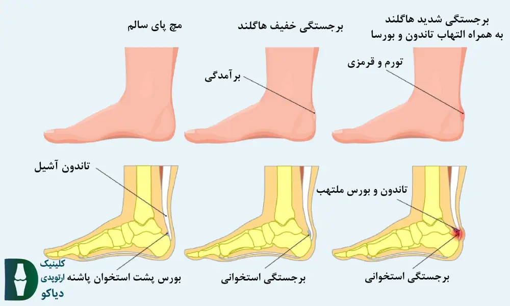 درمان مناسب هاگلند