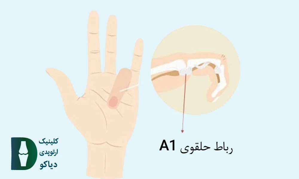 انگشت ماشه‌ای