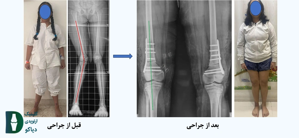 قبل از جراحی