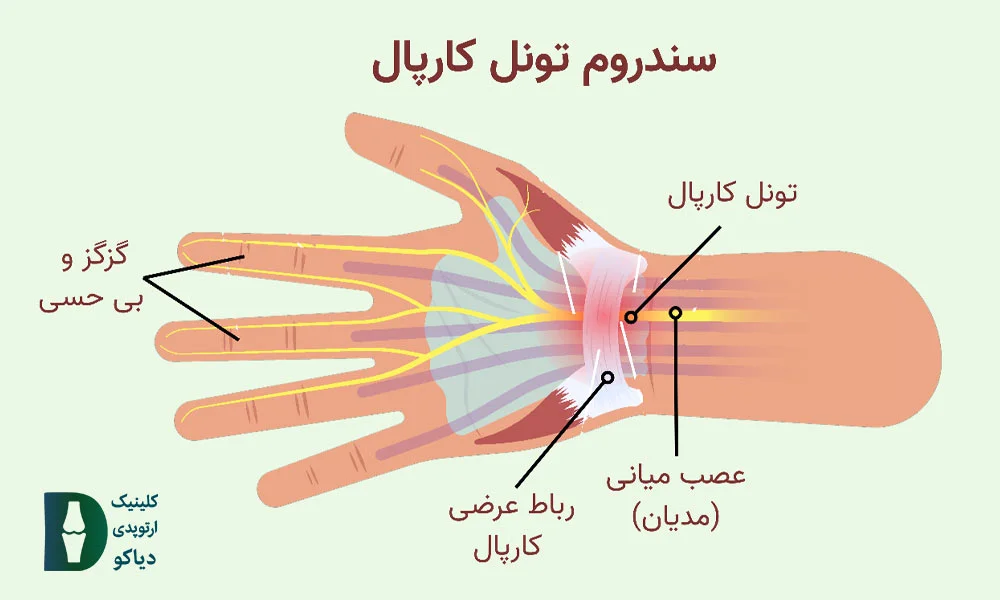 سندروم تونل کارپال