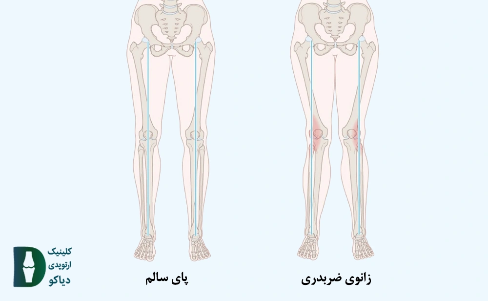 جراحی زانو ضربدری