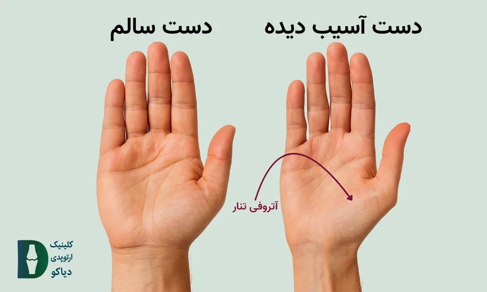  تنگی کانال دست شدید