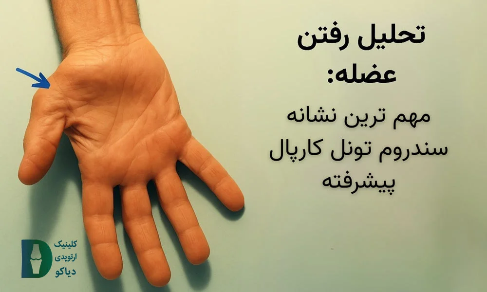تحلیل رفتن عضله