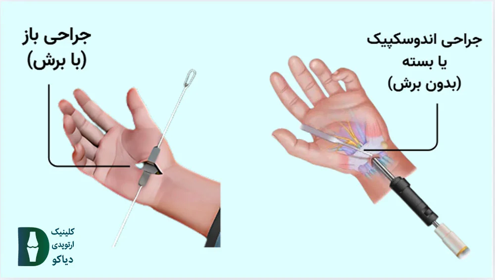 اندوسکوپیک