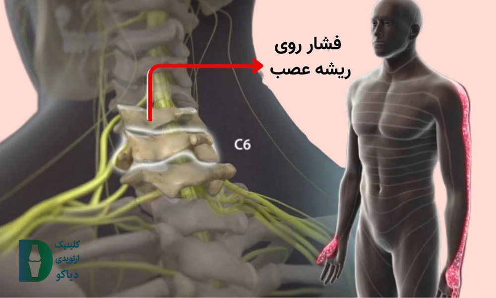 فشار روی اعصاب گردن