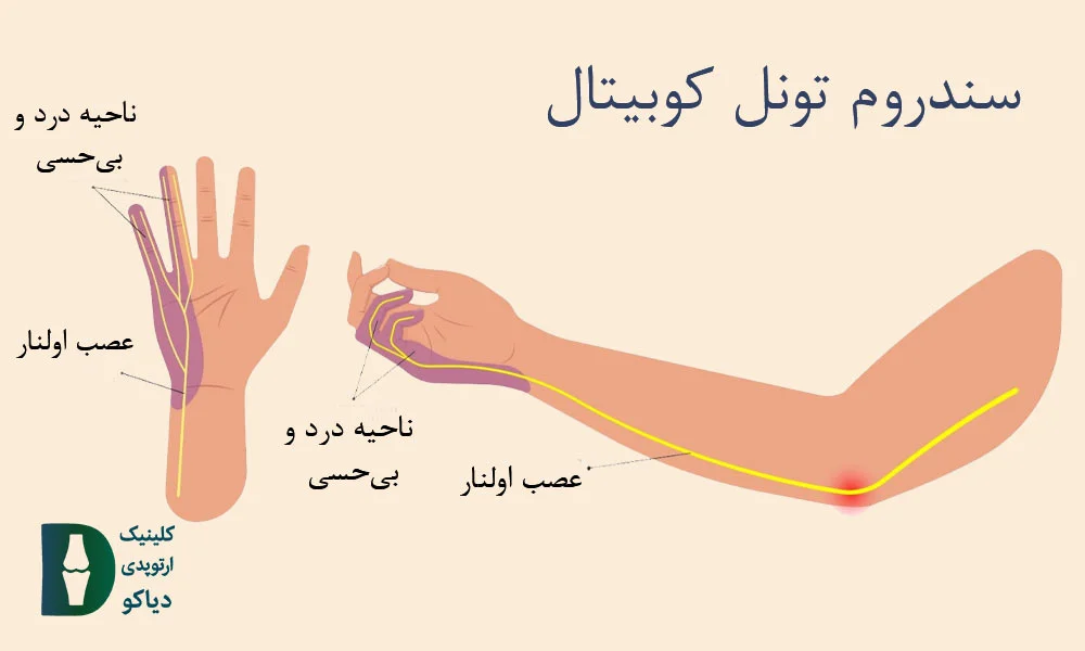 گیر افتادن عصب اولنار (سندروم تونل کوبیتال)