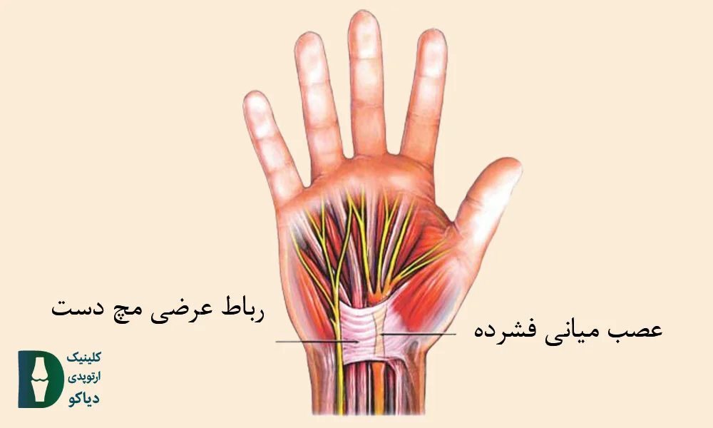 سندرم تونل کارپال