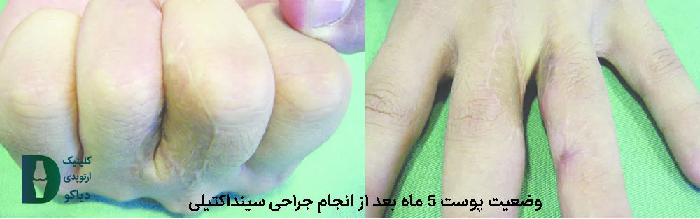 وضعیت پوست 5 ماه بعد از انجام جراحی سینداکتیلی
