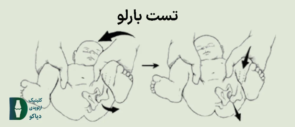 تست بارلو