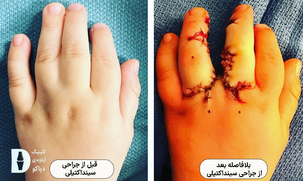 بلافاصله بعد از جراحی سینداکتیلی