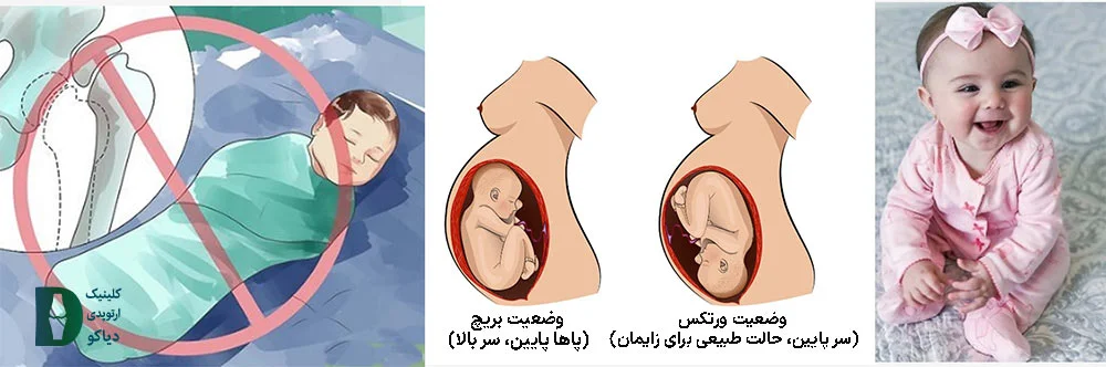 وضعیت ورتکس