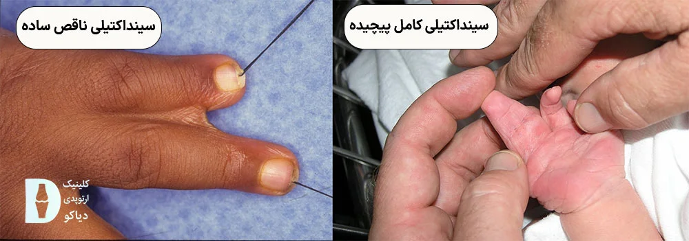 ارزیابی نوع سینداکتیلی