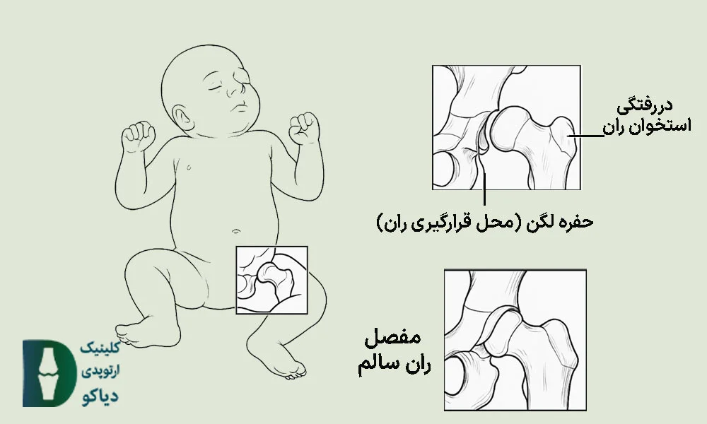 دررفتگی مادرزادی لگن