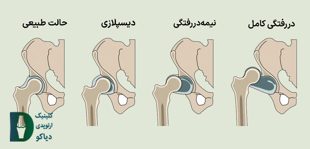 دررفتگی مادرزادی لگن چیست
