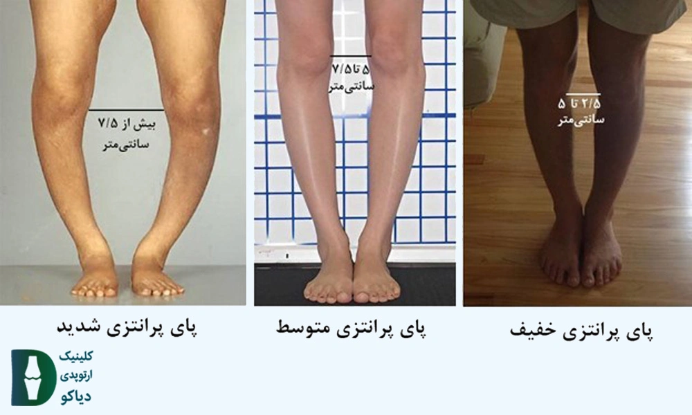 بررسی شدت انحراف زانو