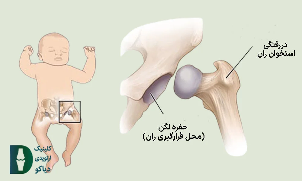 دررفتگی مفصل ران