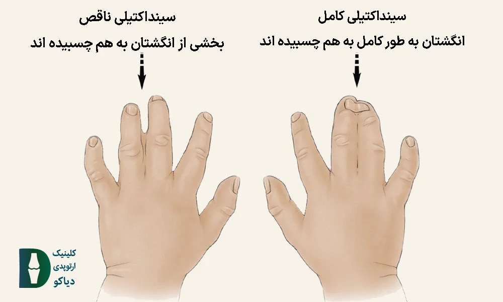 برای انجام جراحی، ابتدا باید نوع سینداکتیلی مشخص شود 