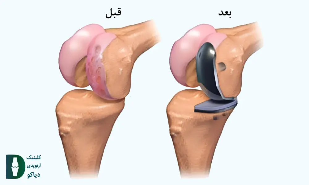 جراحی و نقاهت تعویض جزئی مفصل زانو