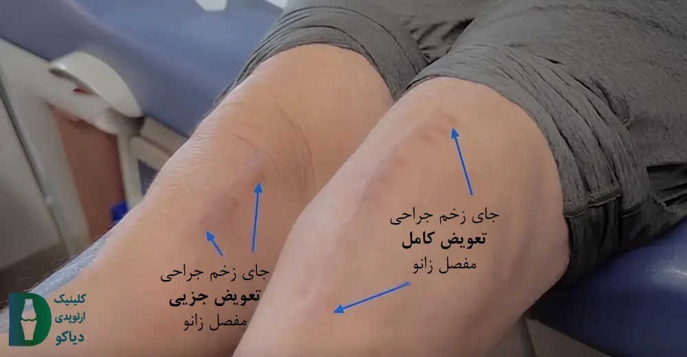 روزهای اول بعد از جراحی