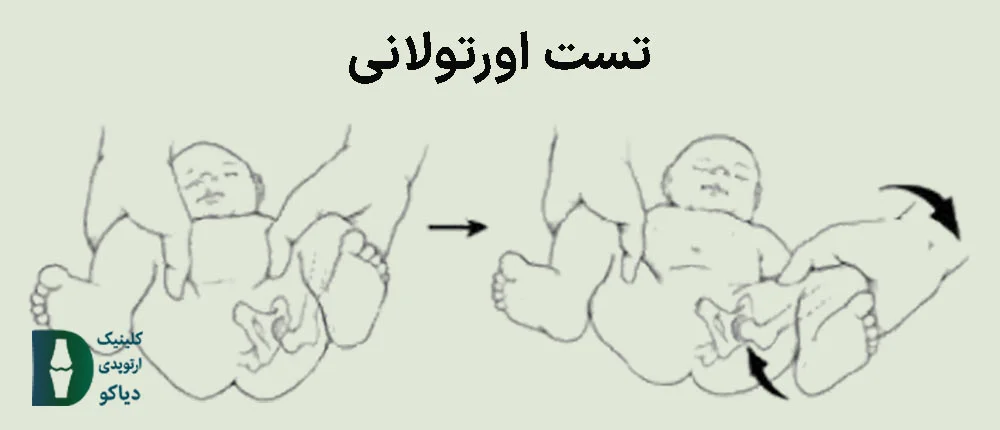 تست اورتولانی