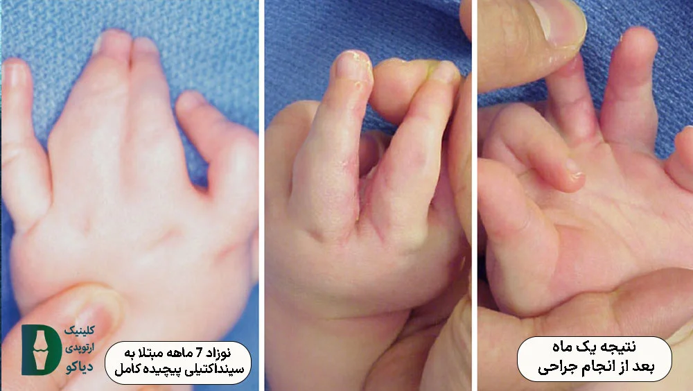 نوزاد 7 ماهه مبتلا به سینداکتیلی پیچیده کامل