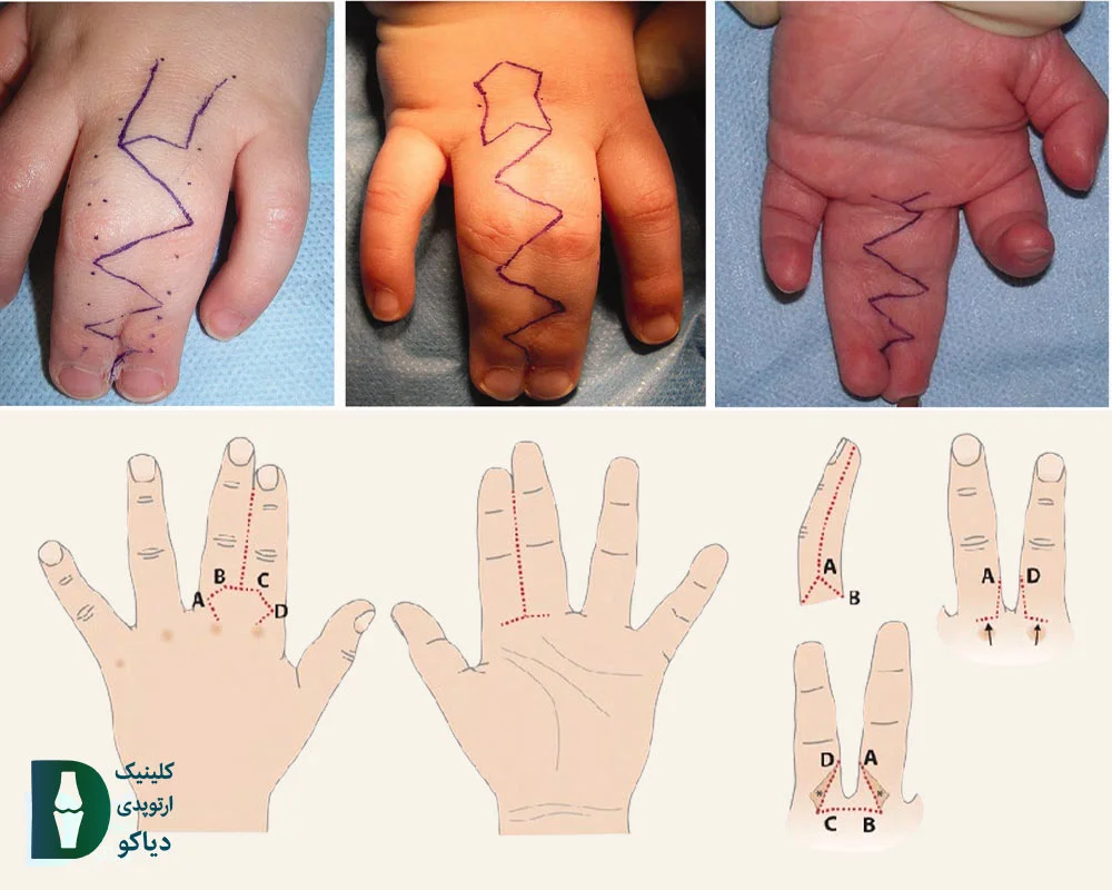 سینداکتیلی ناقص