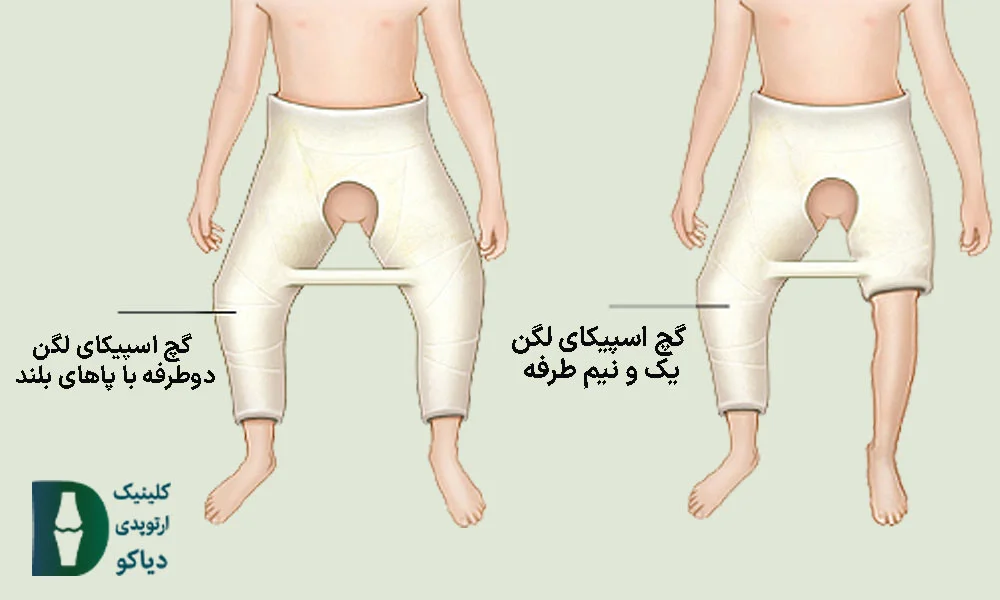 گچ‌گیری اسپیکا