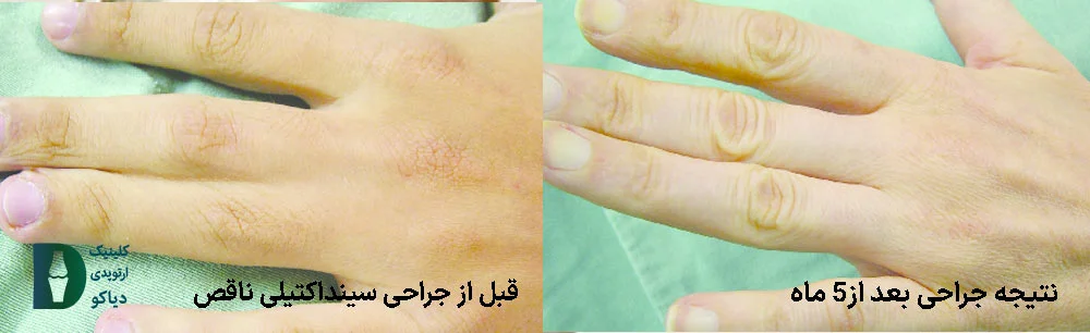 سینداکتیلی ناقص بین انگشت سوم و چهارم