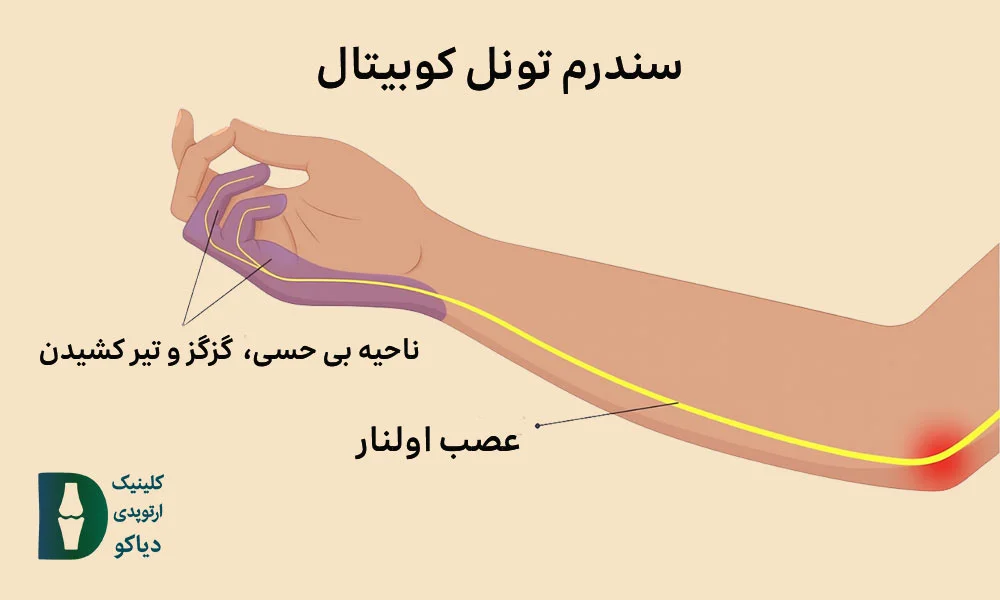 ناحیه بی حسی، گزگز و تیر کشیدن