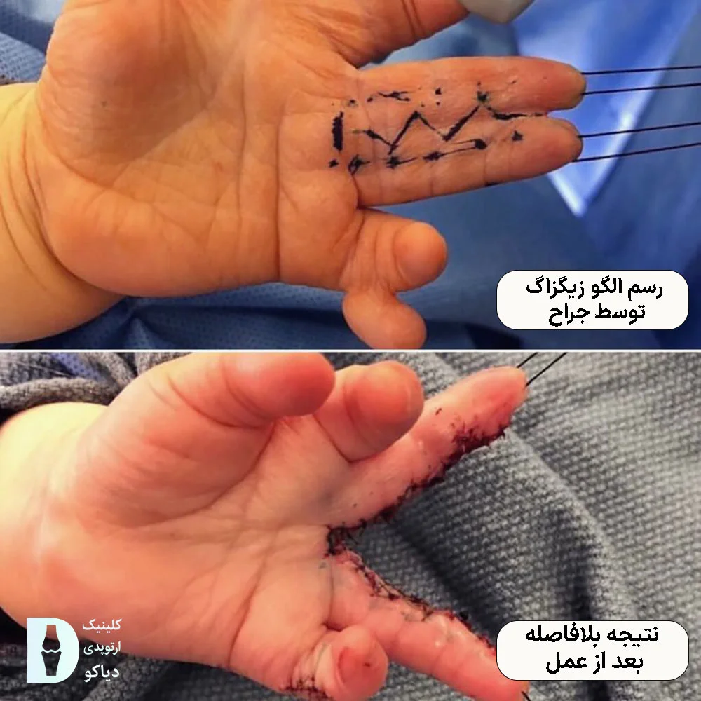 رسم الگو زیگزاگ توسط جراح