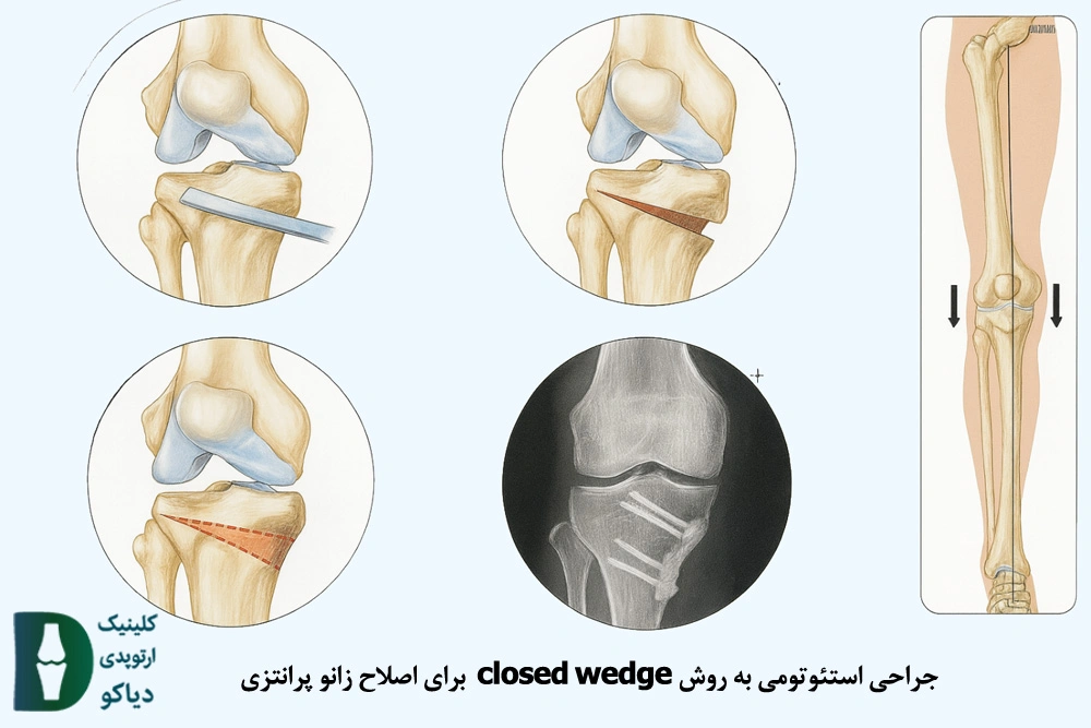closed wedge