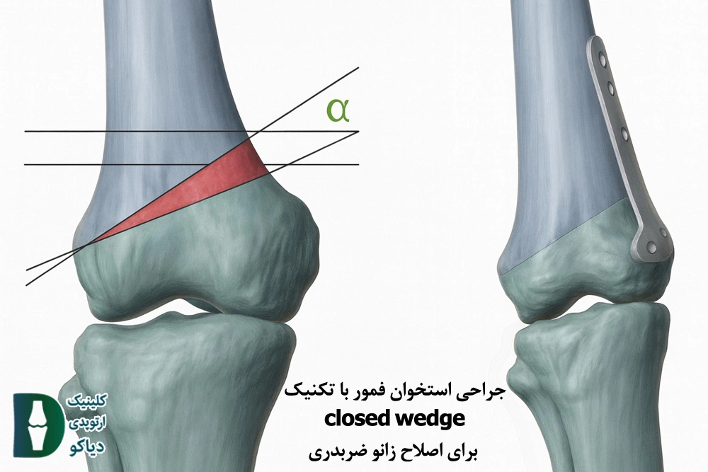 جراحی استخوان فمور