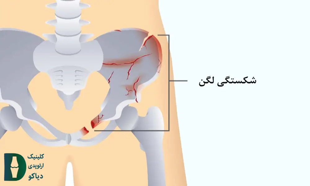 شکستگی لگن