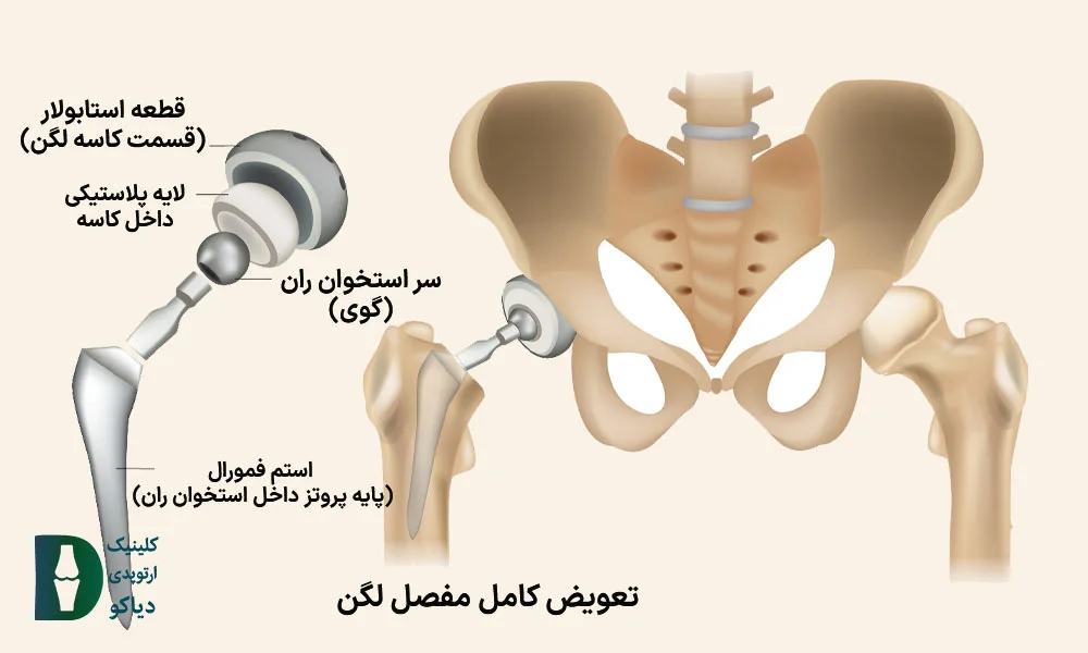  قطعه استابولار (قسمت کاسه لگن)