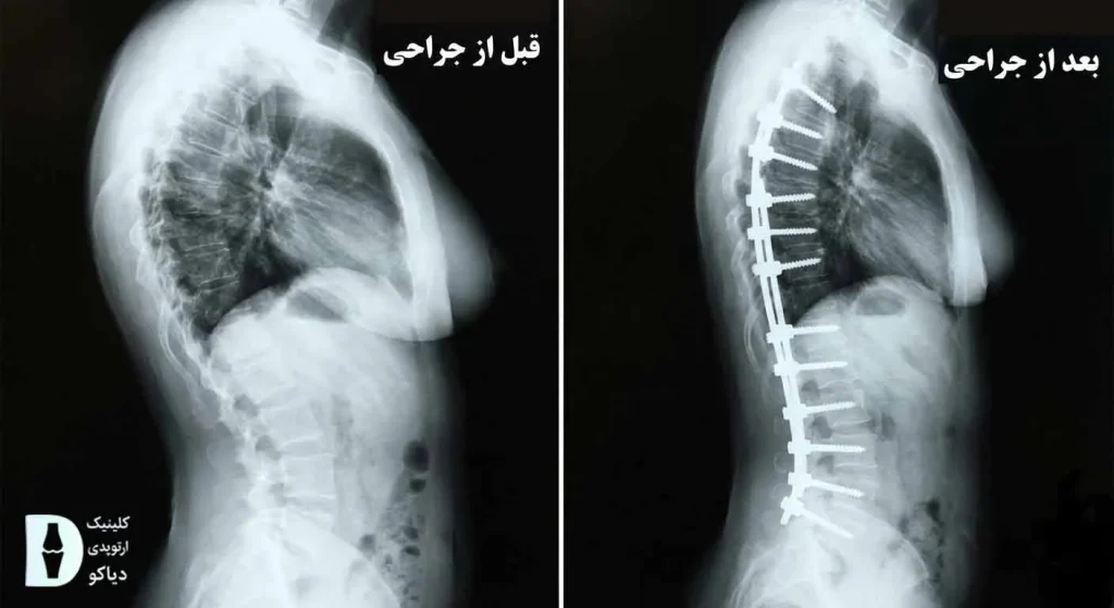 جراحی کیفوز