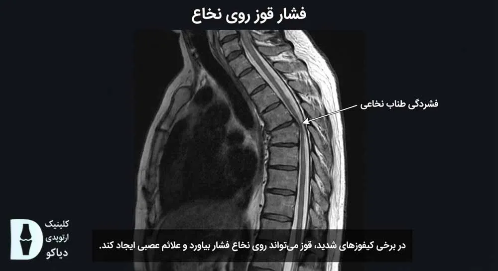 علائم عصبی کیفوز
