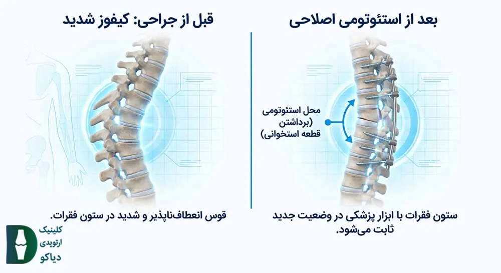 استئوتومی