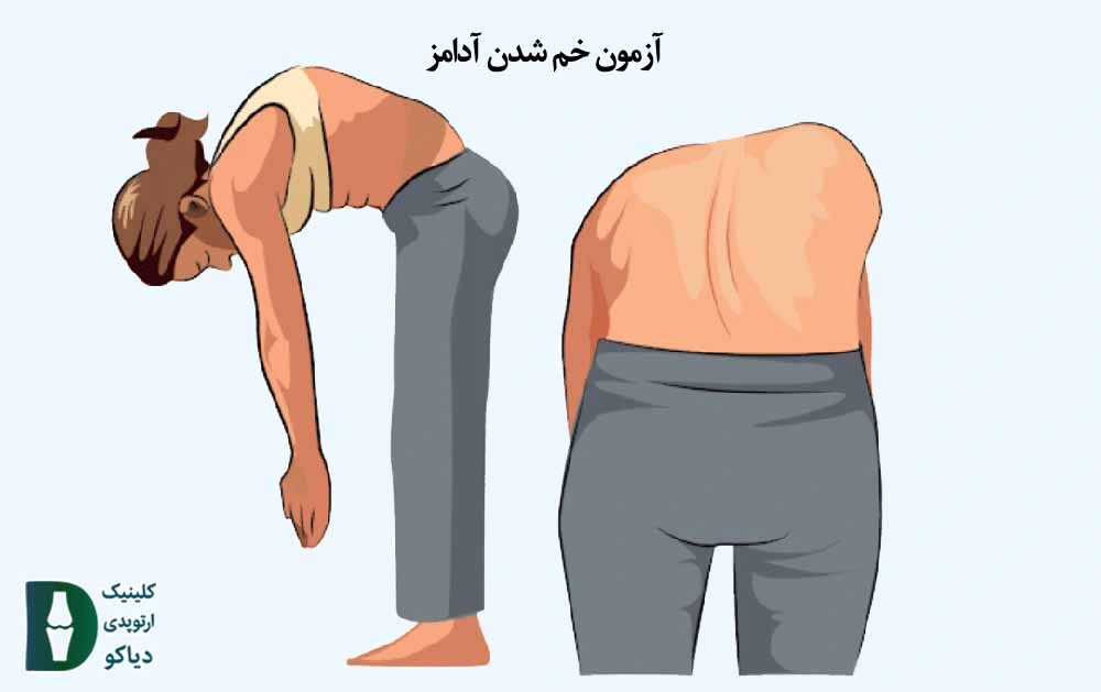 خم شدن آدامز
