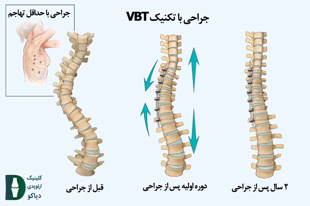 جراحی با تکنیک VBT