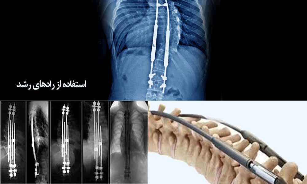 بستن مهره‌ها با طناب