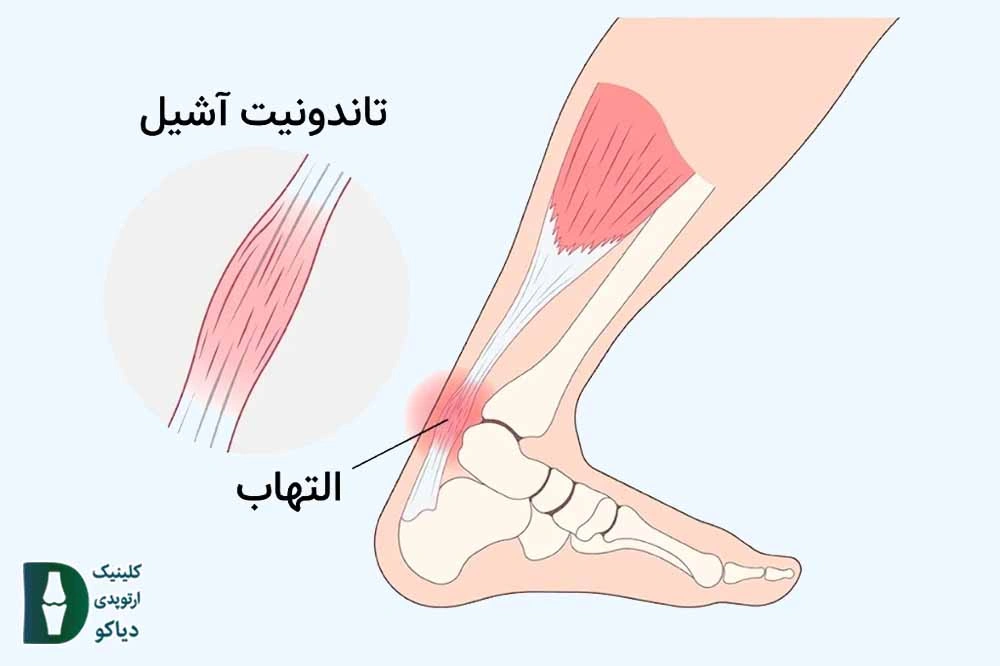 التهاب تاندون آشیل